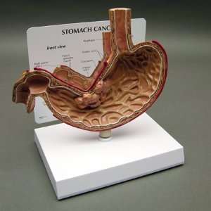 Stomach Cancer Anatomical Model  Industrial & Scientific